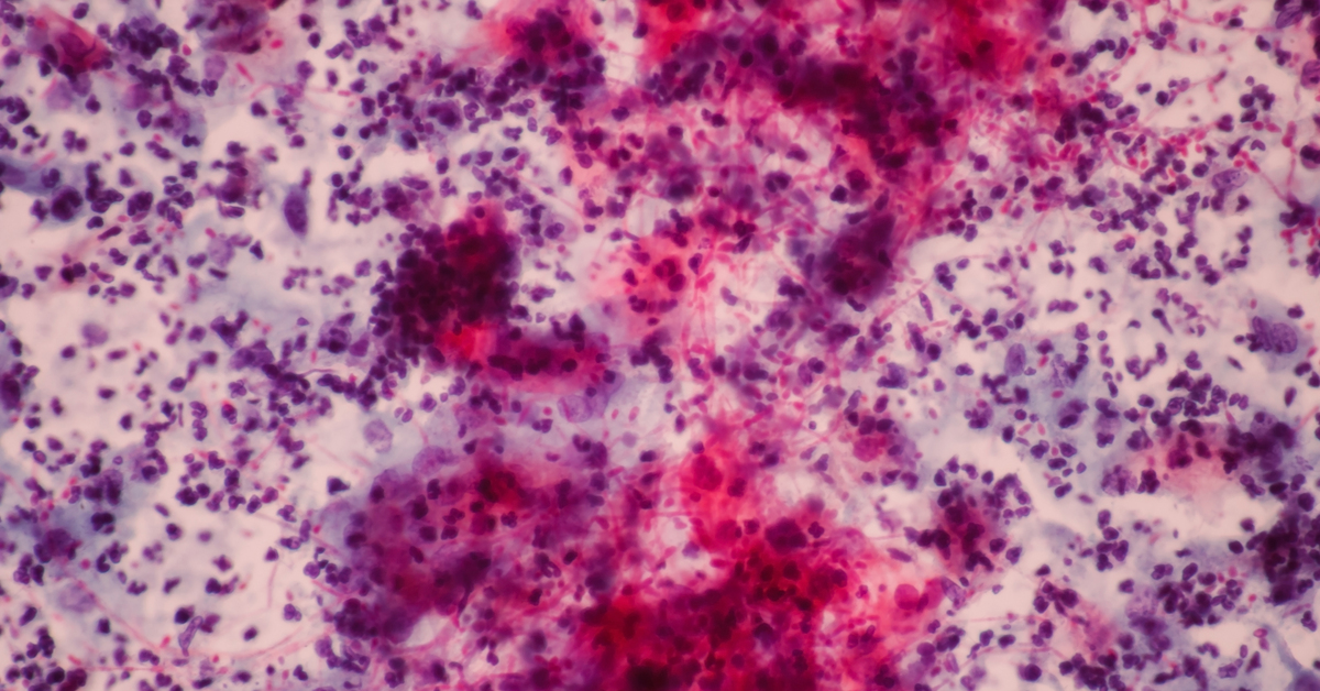 Kanserli çocuk sayısı her geçen yıl artıyor